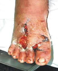 Resultado de imagen de heridas por machacamiento