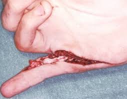 Resultado de imagen de heridas por laceración