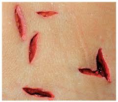 Resultado de imagen de heridas punzocortantes